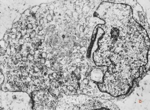 F,55y. | omentum - rhabdomyosarcoma F,55y. | omentum - rhabdomyosarcoma